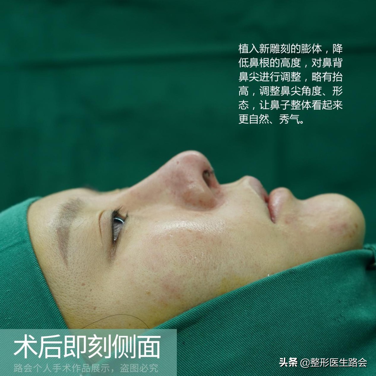 一定得惊艳才好看吗,膨体鼻整形全过程