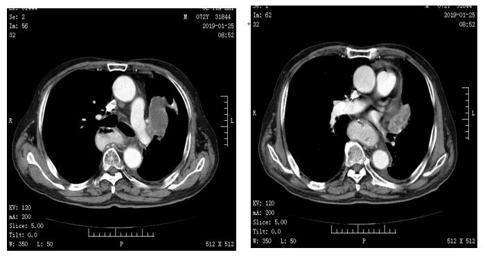 安罗替尼适合何种肺癌,柳暗花明好人一生平安