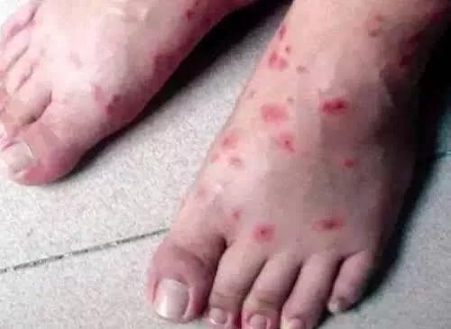 红火蚁咬伤后几天毒性会消退,红火蚁的毒性是属于酸性还是碱性