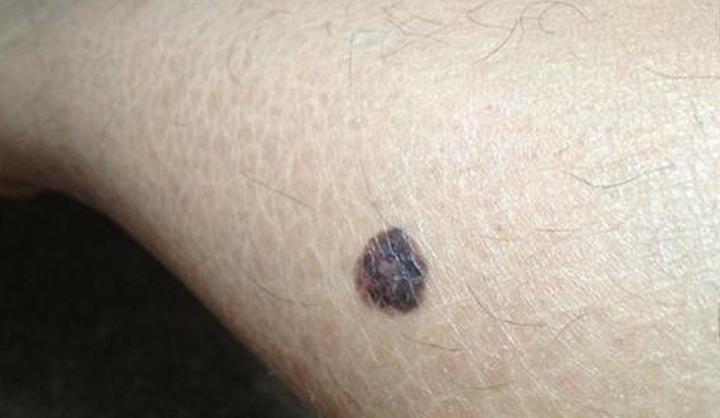 路边摆摊点痣用什么点痣,路边点痣和正规医院点痣区别