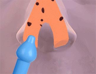 鼻塞流鼻涕如何快速缓解,感冒流鼻涕鼻塞睡觉怎么缓解