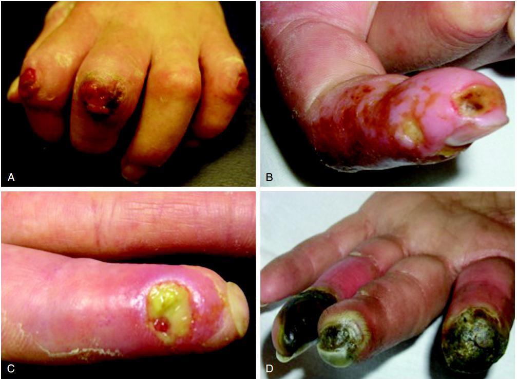 多发性硬化症和系统性硬皮病,系统性硬皮病有什么症状