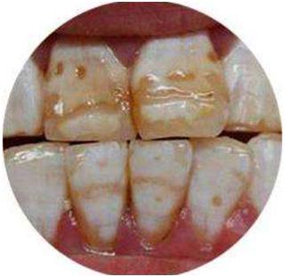 牙齿为什么会出现两种颜色,牙齿变色变成黑色是什么原因