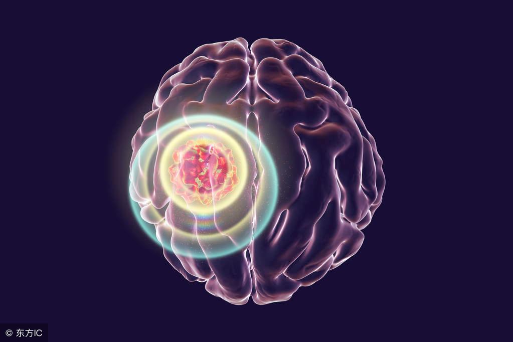 啥是脑癌,什么是脑胶质肿瘤