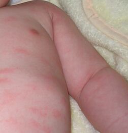 一岁儿童荨麻疹最简单自愈方法,儿童麻疹症状