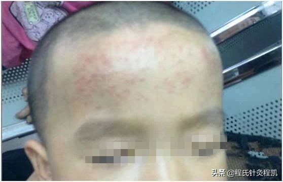 8个月宝宝发烧退热贴贴哪里,儿童发烧贴退热贴有没有用