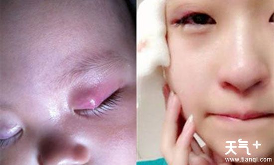 眼睛皮里面长了一个包,眼睛长包会导致视力变弱吗