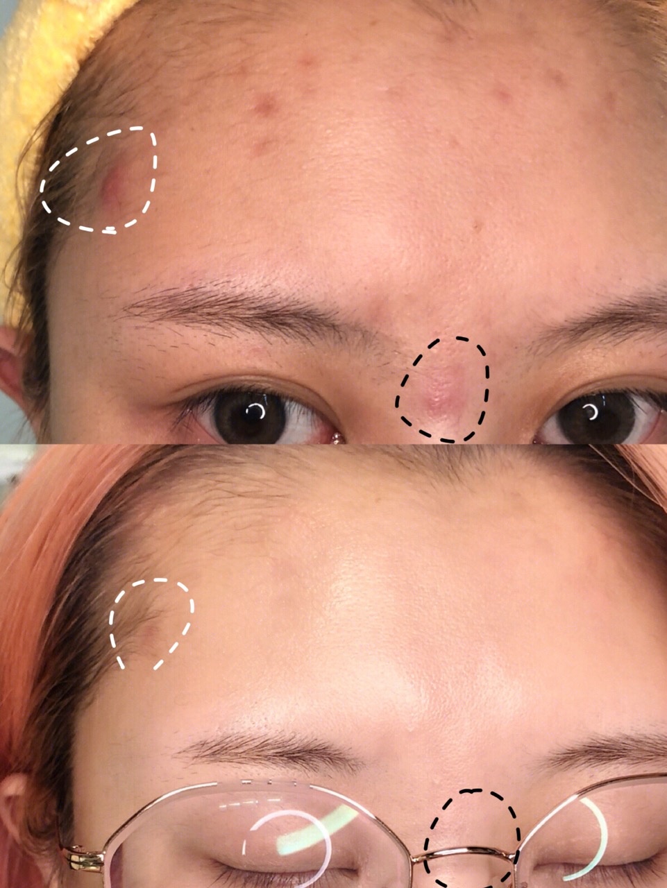 这些网红祛痘药膏你用对了吗,最红祛痘祛疤药膏测评