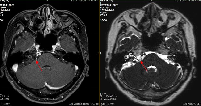 面部抽筋跳动手术怎么做,脸部护理抽筋