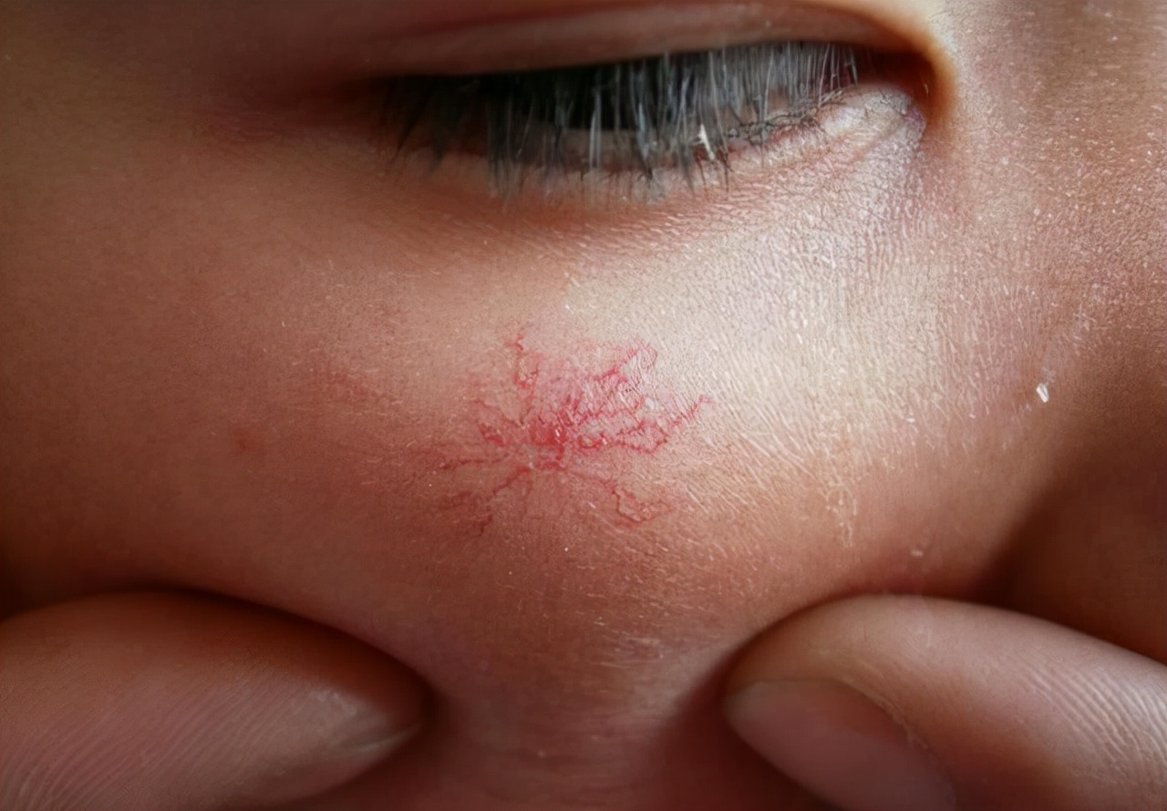 身上莫名其妙的长小红痣一样疙瘩,身上起了小红点像痣一样怎么治疗