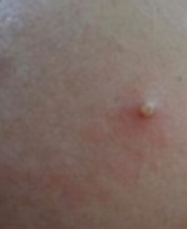 挤痘是正确的吗,关于挤痘痘的几点忠告