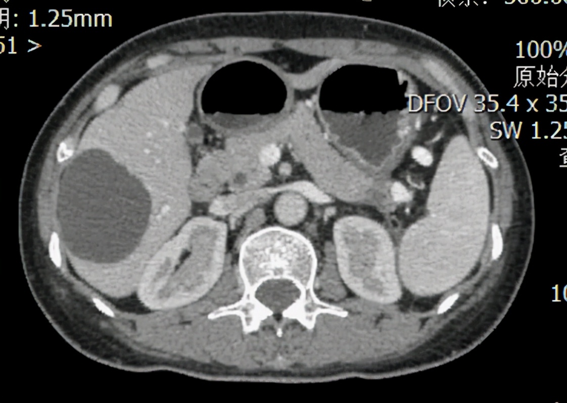 胰腺腺鳞癌手术后能生存几年,胰腺腺癌与胰腺鳞癌