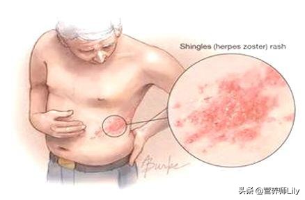 患上带状疱疹做好4件事能少受罪,得了带状疱疹需注意的事项