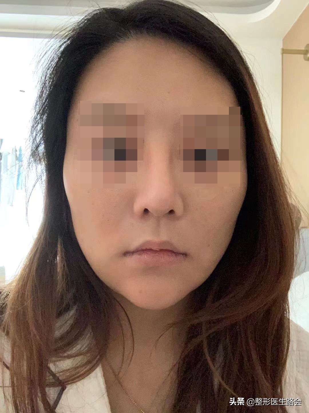 一定得惊艳才好看吗,膨体鼻整形全过程