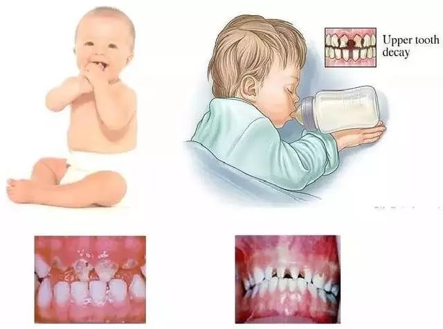 小孩得了奶瓶龋该怎么治疗,宝宝牙齿奶瓶龋怎样治