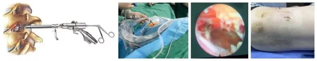 中西医结合治疗脊椎病，个性化定制治疗方案