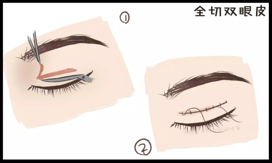 割双眼皮术前术后对比图,割双眼皮术前需要注意事项