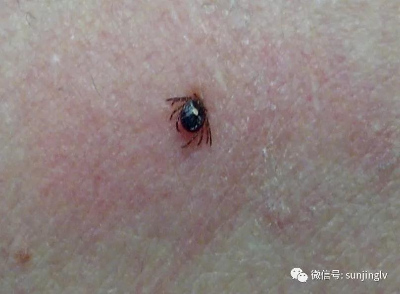 吃红肉过敏是怎么回事,吃红肉过敏怎么治