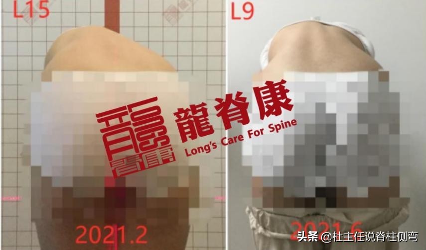 13岁女孩脊柱侧弯能治愈吗,13岁女孩脊柱侧弯21度还能矫正吗