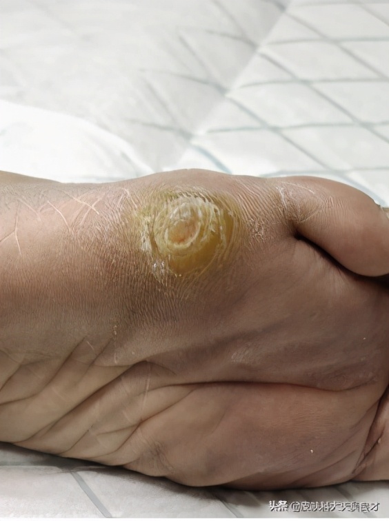 初期鸡眼和跖疣的区别,鸡眼和跖疣最简单的区别