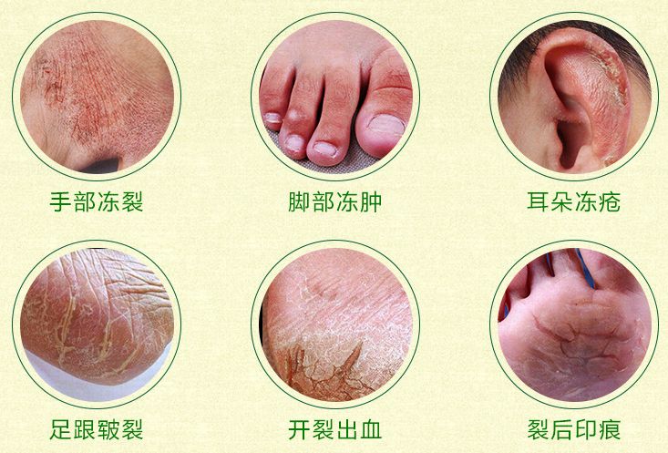 手脚皮肤干裂怎样快速保湿,缓解手脚干裂的小妙招