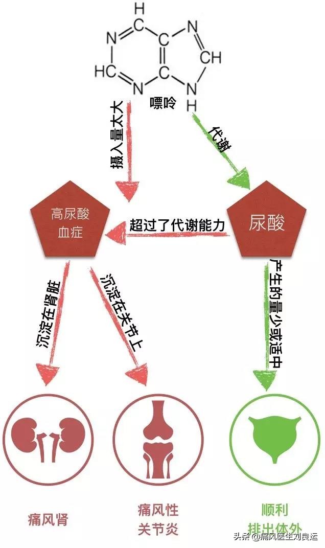非布司他可以治痛风,痛风患者也不能随便自行用药降尿酸