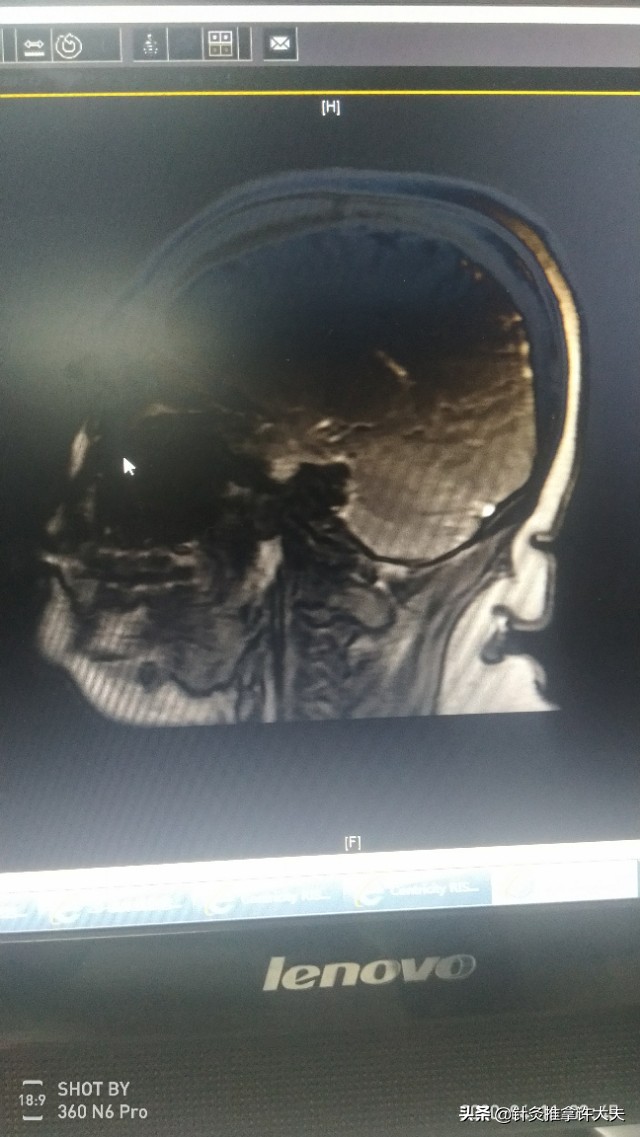 脖子摸着有点包是咋回事,脖子摸着硬怎么回事