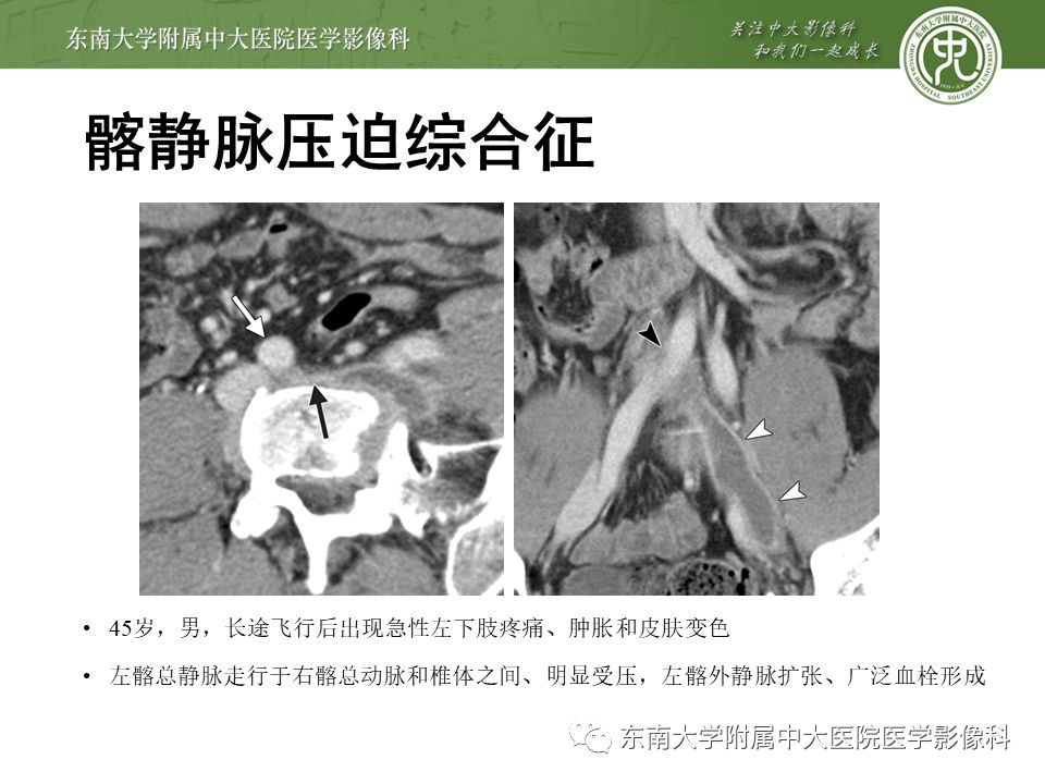 肠系膜上动脉压迫综合征挂什么科,肠系膜上动脉压迫综合征手术费用