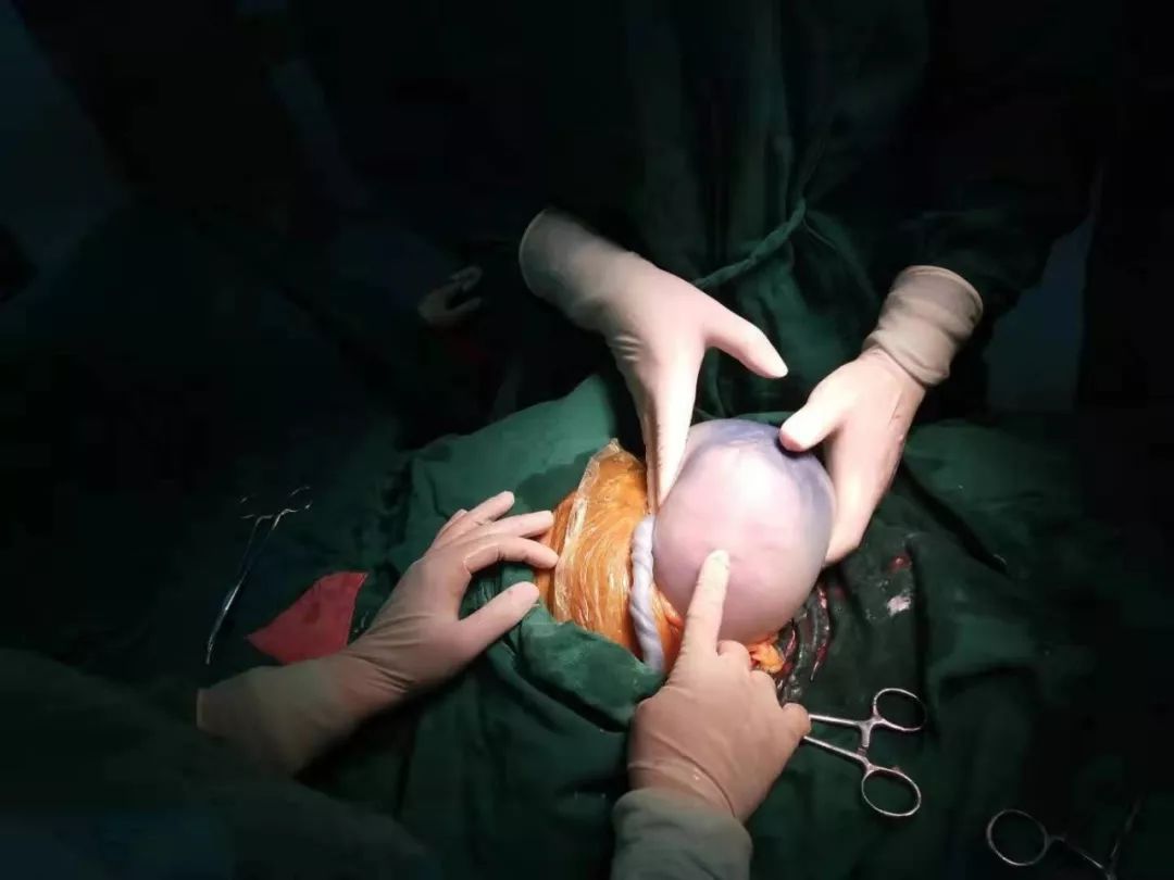 36岁的三明少妇小玲：诞下“带壳宝宝”，男婴像个透明鸡蛋