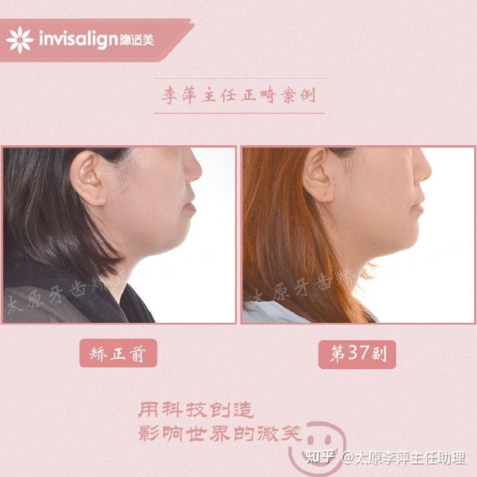 太原牙齿矫正靠谱吗,太原成人隐形牙套牙齿不齐