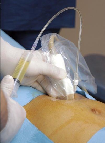 唐筛低风险有没有生出唐氏儿,有唐氏临界风险生出唐氏宝宝的吗