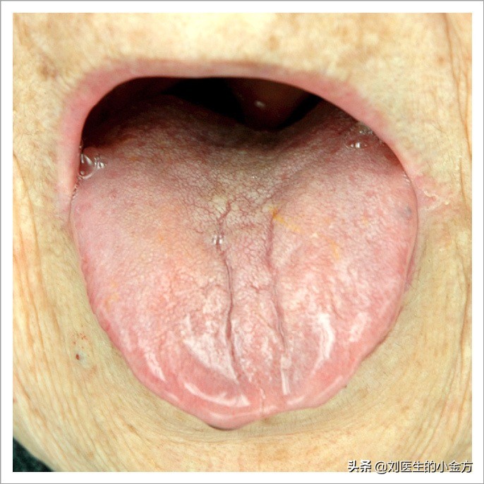 中医舌诊图解100例,中医舌诊图与舌诊口诀