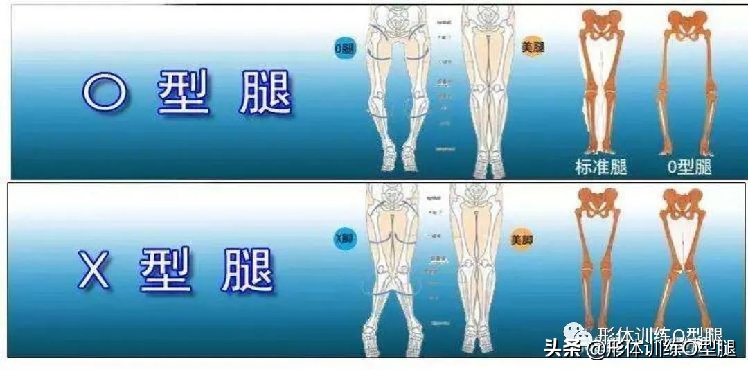 o型腿罗圈腿,后期形成的罗圈腿怎么自我矫正