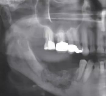 服用阿司匹林可以服丹参吗,服用阿司匹林能服用甲硝唑吗