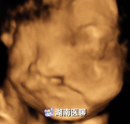 错过预约四维彩超最佳时间怎么办,四维彩超错过预约时间了怎么办