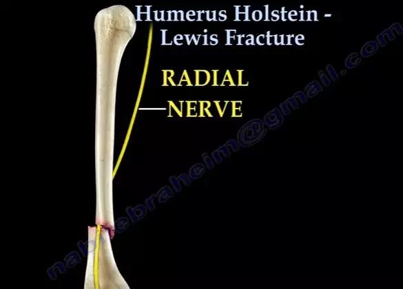 几种严重骨折医学名称,常见的骨折有哪些名称