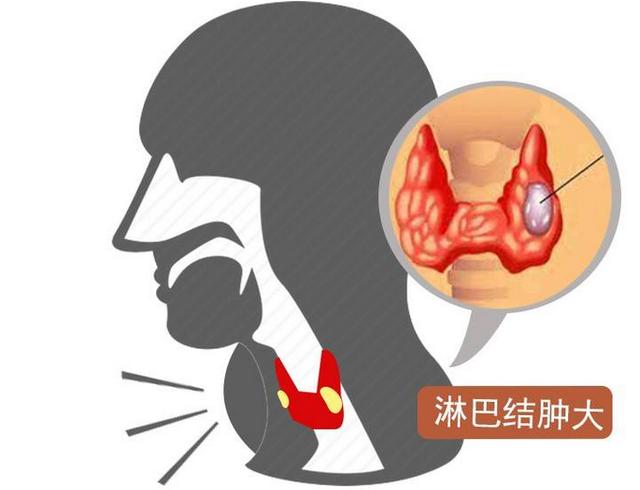 咽喉不舒服像是感冒似的吃什么药,咽喉不适就是不敢去医院