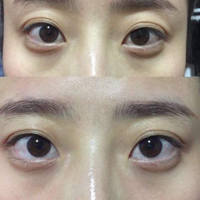 晓姿4d眼膜用了皱纹越来越严重,axxzia晓姿眼膜怎样用