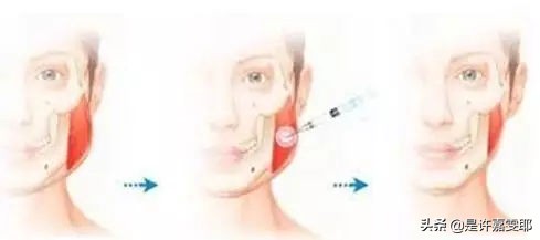 瘦脸针其实副作用挺大的吧,关于瘦脸的知识