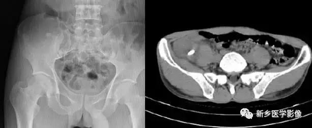 腹部平片能看到结石吗,腹部高密度结节影是什么