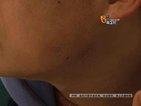 打完瘦脸针青蛙腮正常吗,打完瘦脸出现青蛙腮