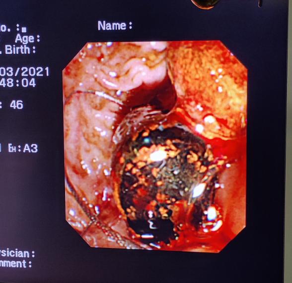 消化内镜技术近5年的新进展,腹腔镜下胆总管切开取石术恢复快