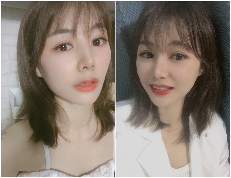 光子嫩肤540,480nm光子嫩肤