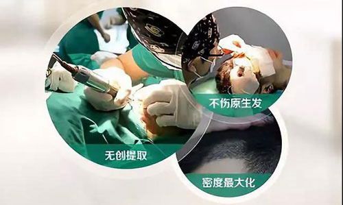 治疗脱发有必要做毛囊检测吗,脱发毛囊检测是怎么样检测的