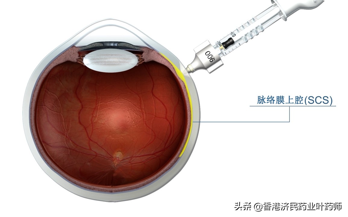 治疗葡萄膜炎的生物制剂有什么,葡萄膜炎专用药