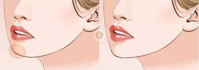 玻尿酸的效果,玻尿酸的美容优势有哪些