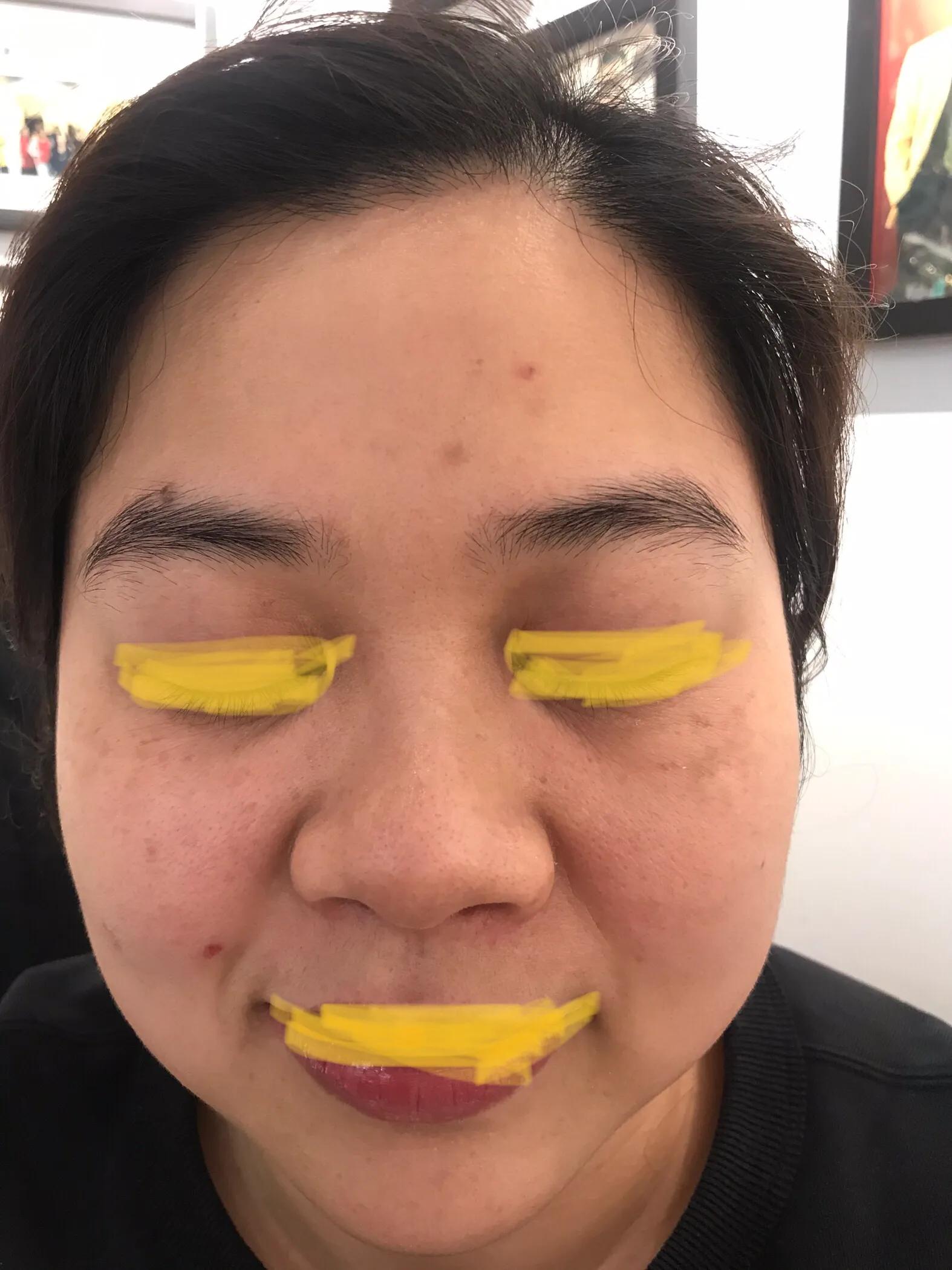 激光祛斑后斑片更大更黑了怎么办,两次祛斑还是反黑