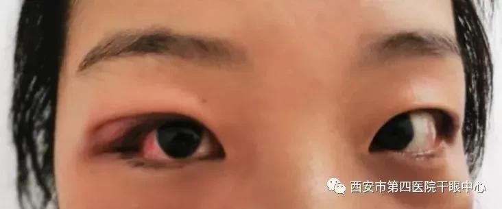 麦粒肿攻略,麦粒肿如何自己正确涂药膏