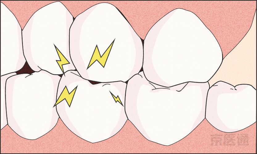 磨牙不好是真的吗,磨牙的危害与注意事项