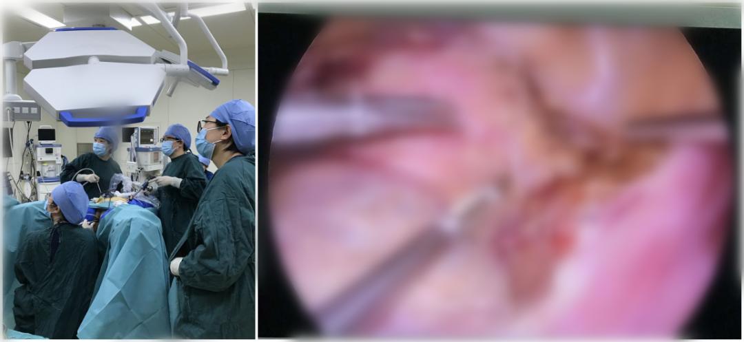 太原市中心医院MDT精诚合作完成腹腔镜下子宫瘢痕部位病灶切除术